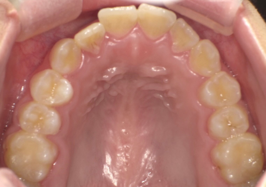 前歯のガタつきが気になる思いっきり笑えない