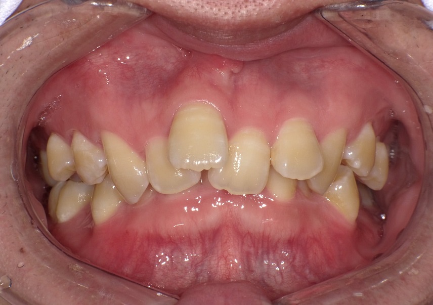 他院で矯正相談したら抜歯しての矯正になると言われた