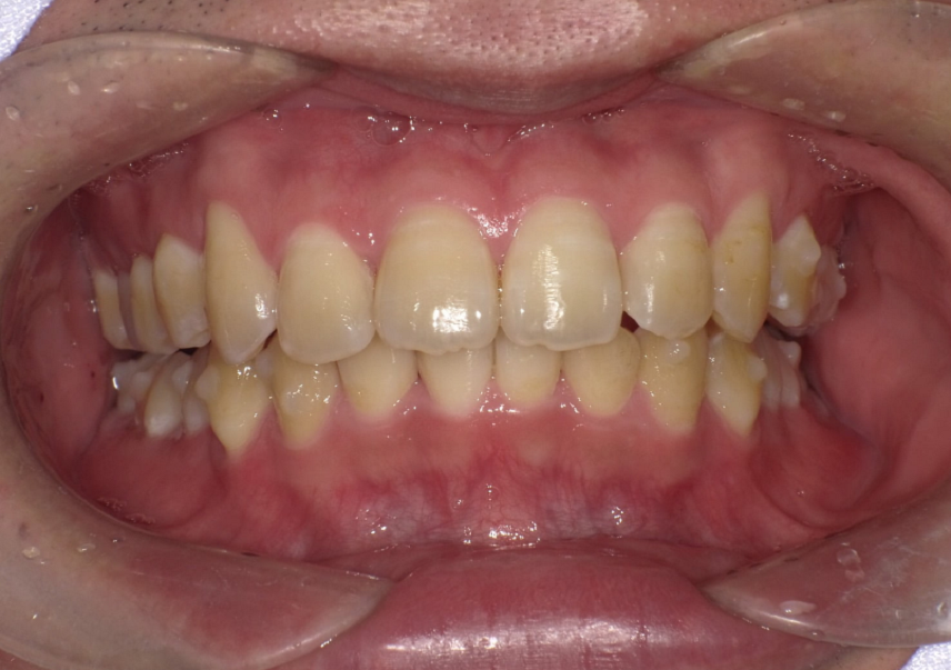 他院で矯正相談したら抜歯しての矯正になると言われた