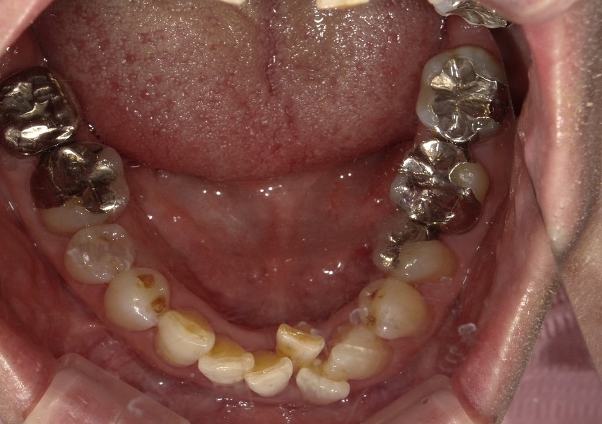 左にずれている将来入れ歯になりたくないため予防