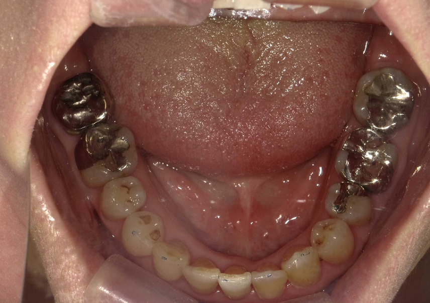 左にずれている将来入れ歯になりたくないため予防